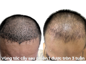 Sau Cấy Tóc Tự Thân 3 Tuần – Phiên 1 (2000 Nang)