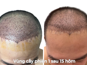 Alternative view of Sau Cấy Tóc Tự Thân 3 Tuần – Phiên 1 (2000 Nang)