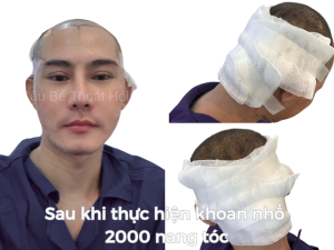 Alternative view of Sau Cấy Tóc Tự Thân 13 Hôm - Phiên 1 (2000 Nang)