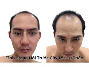 Trước Cấy Tóc Tự Thân - Phiên 1 (2000 Nang)
