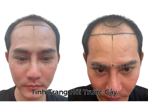 Alternative view of Trước Cấy Tóc Tự Thân - Phiên 1 (2000 Nang)