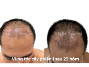 Alternative view of Sau Cấy Tóc Tự Thân 1 Tháng – Phiên 1 (2000 Nang)