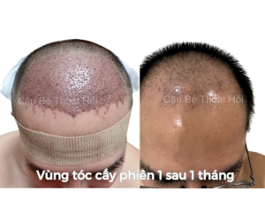 Sau Cấy Tóc Tự Thân 1 Tháng – Phiên 1 (2000 Nang)