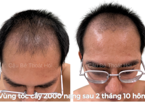 Alternative view of Sau Cấy Tóc Tự Thân 3 Tháng – Phiên 1 (2000 Nang)