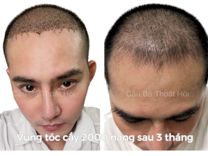 Sau Cấy Tóc Tự Thân 3 Tháng – Phiên 1 (2000 Nang)