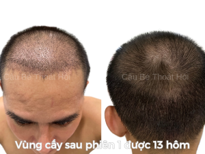 vùng hiến nang và vùng cấy tóc tự thân sau 13 hôm