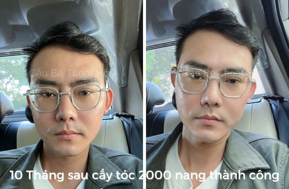 10 Tháng sau cấy tóc tự thân điều trị rụng tóc hói đầu thành công cậu bé thoát hói. Tuy 2000 nang chưa đủ làm tóc mình dày nhưng mình thấy tự tin hơn nhiều và trông đợi thêm phần còn lại ở phiên 2 cấy tóc.