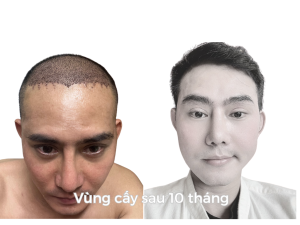 Sau Cấy Tóc Tự Thân 10 Tháng - Phiên 1 (2000 Nang)