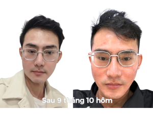 Alternative view of Sau Cấy Tóc Tự Thân 10 Tháng - Phiên 1 (2000 Nang)