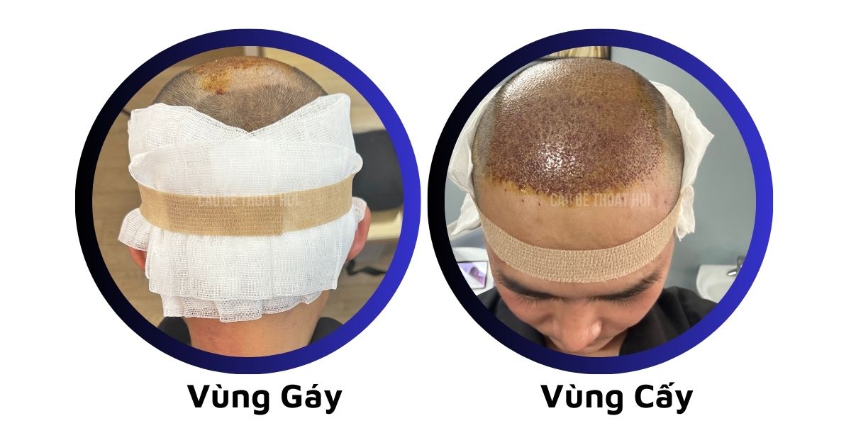 sau cấy tóc tự thân bằng công nghệ cấy DHI trị hói thành công của cậu bé thoát hói