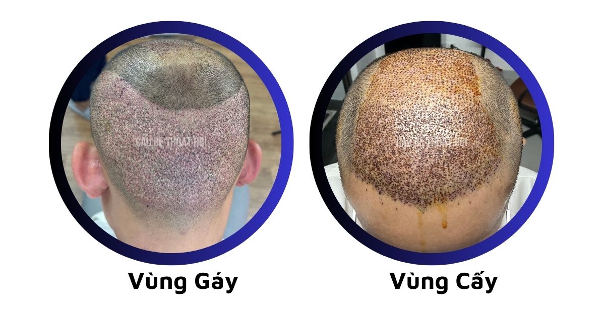 sau cấy tóc tự thân bằng công nghệ cấy DHI trị hói thành công của cậu bé thoát hói
