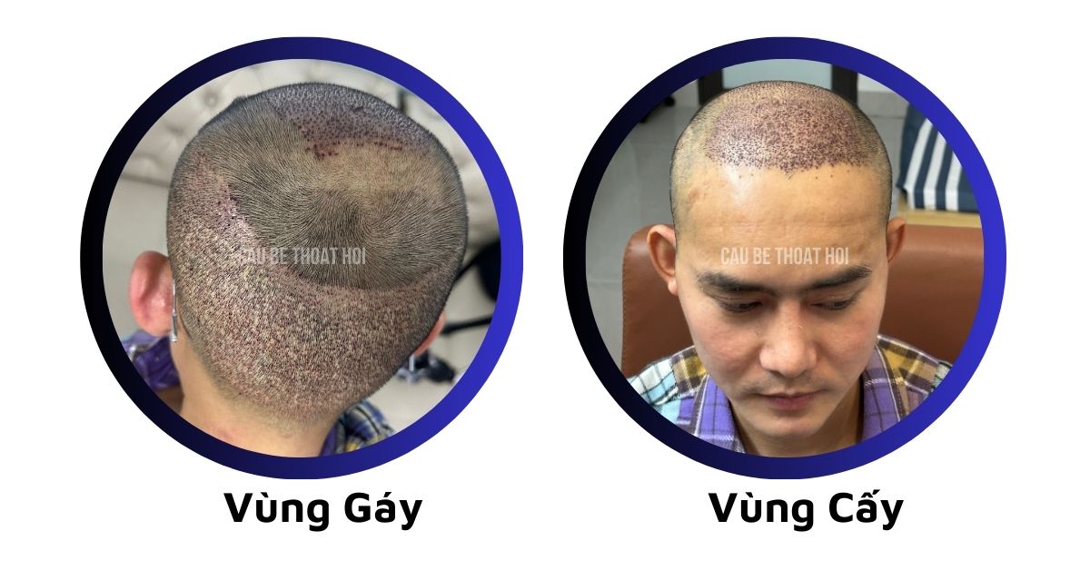 sau cấy tóc tự thân bằng công nghệ cấy DHI trị hói thành công của cậu bé thoát hói