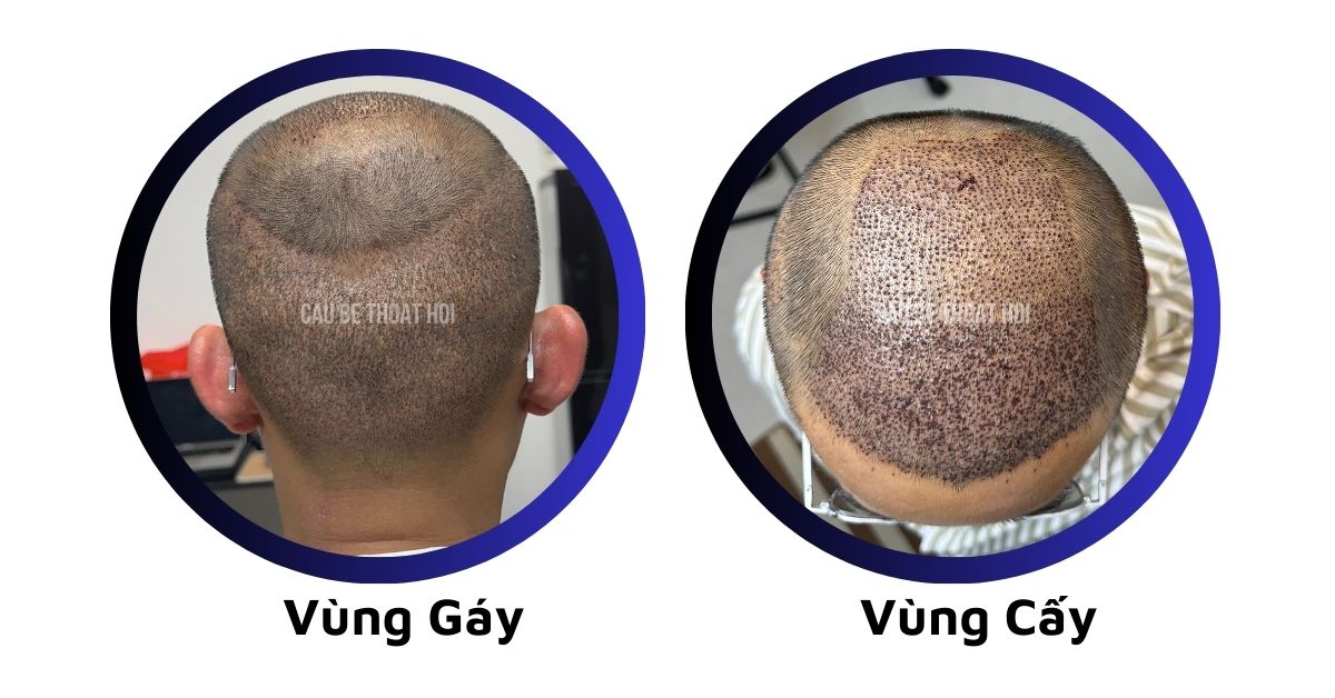 sau cấy tóc tự thân bằng công nghệ cấy DHI trị hói thành công của cậu bé thoát hói