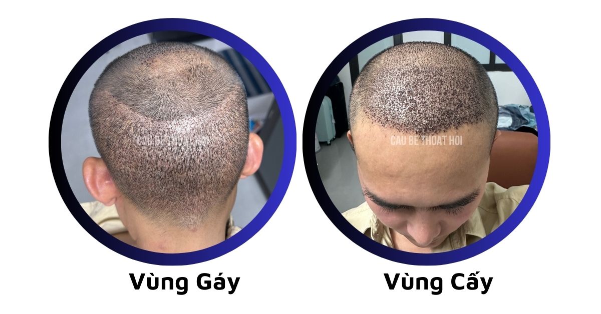 sau cấy tóc tự thân bằng công nghệ cấy DHI trị hói thành công của cậu bé thoát hói