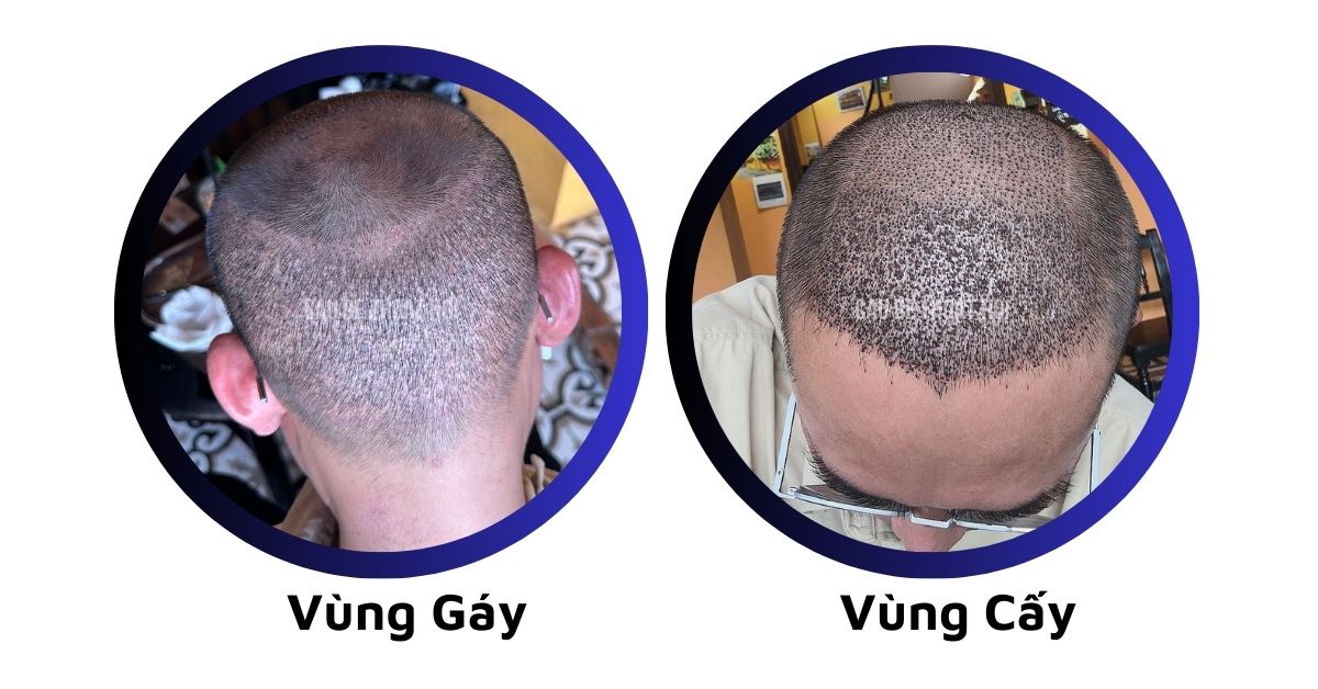 sau cấy tóc tự thân bằng công nghệ cấy DHI trị hói thành công 6 hôm của cậu bé thoát hói