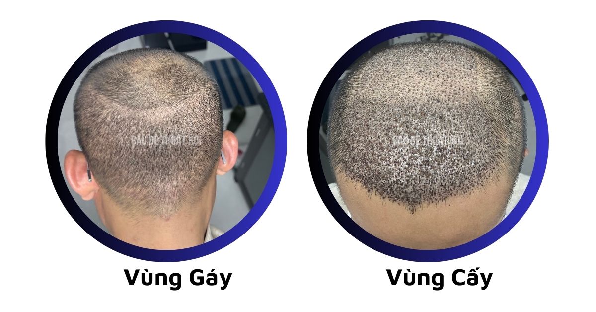 sau cấy tóc tự thân bằng công nghệ cấy DHI trị hói thành công 7 hôm của cậu bé thoát hói