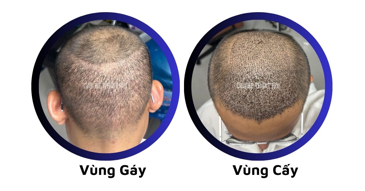 sau cấy tóc tự thân bằng công nghệ cấy DHI trị hói thành công 8 hôm của cậu bé thoát hói
