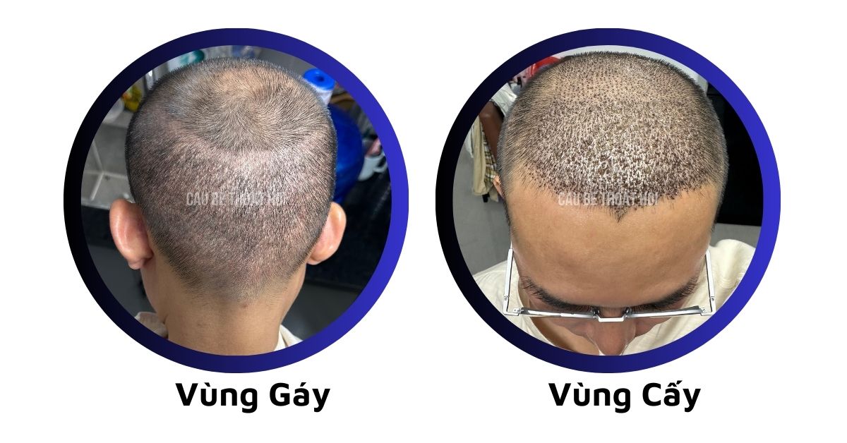 sau cấy tóc tự thân bằng công nghệ cấy DHI trị hói thành công 9 hôm của cậu bé thoát hói