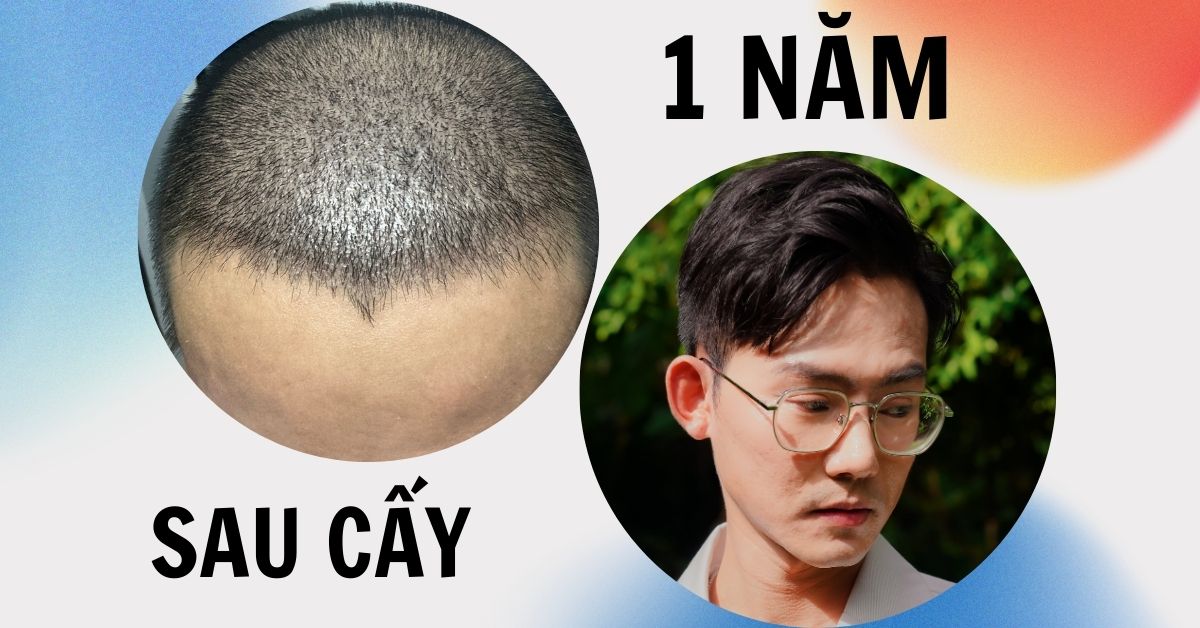 KẾT QUẢ 1 NĂM SAU CẤY TÓC CHỮA HÓI THÀNH CÔNG CỦA CẬU BÉ THOÁT HÓI