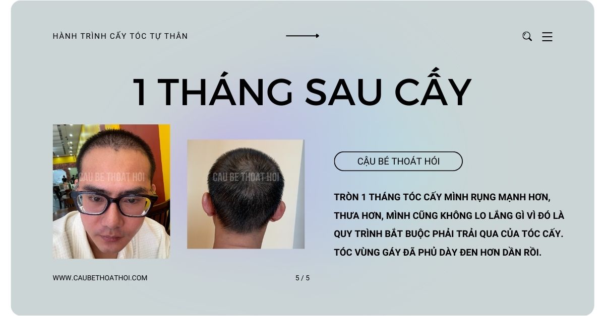 sau cấy tóc chữa hói thành công 1 tháng cậu bé thoát hói bằng công nghệ cấy tóc DHI