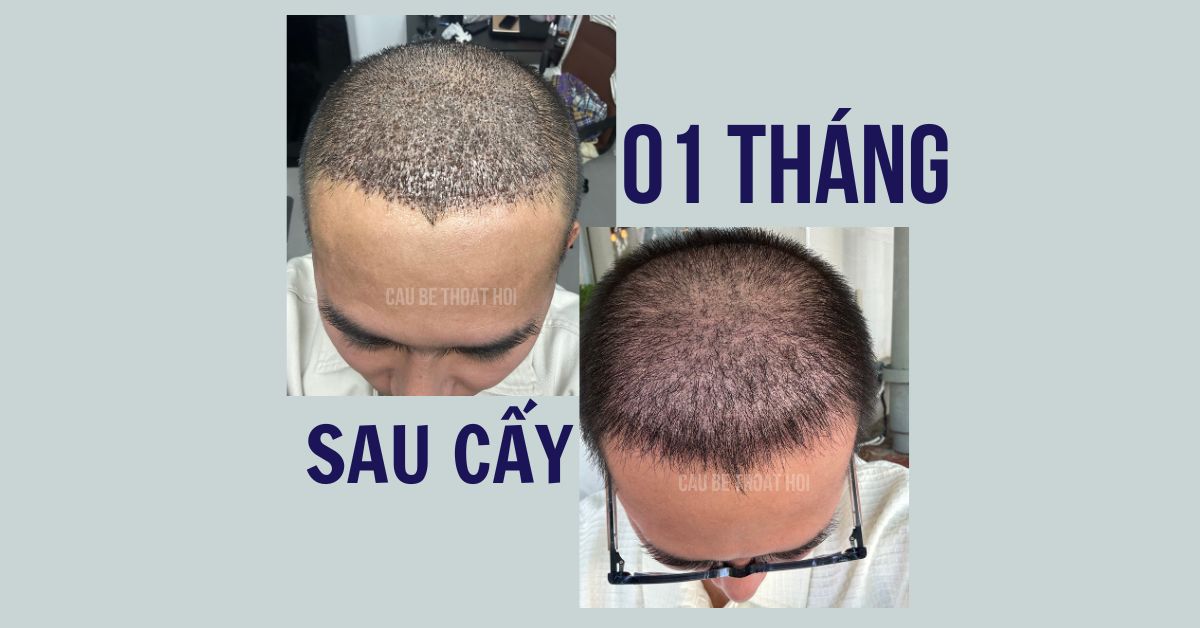 sau cấy tóc chữa hói thành công 1 tháng cậu bé thoát hói bằng công nghệ cấy tóc DHI