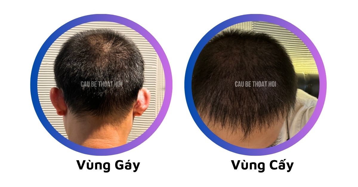 sau 1 tháng 16 hôm cấy tóc tự thân chữa hói bằng công nghệ cấy tóc DHI của cậu bé thoát hói