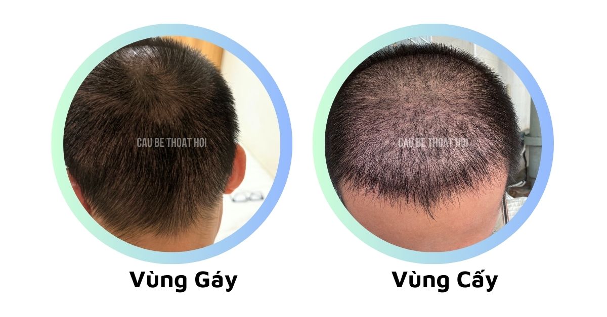 sau cấy tóc chữa hói thành công 1 tháng cậu bé thoát hói bằng công nghệ cấy tóc DHI