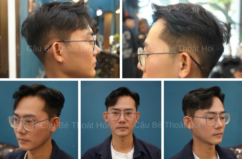 1 năm sau cấy tóc tự thân điều trị rụng tóc hói đầu thành công cậu bé thoát hói