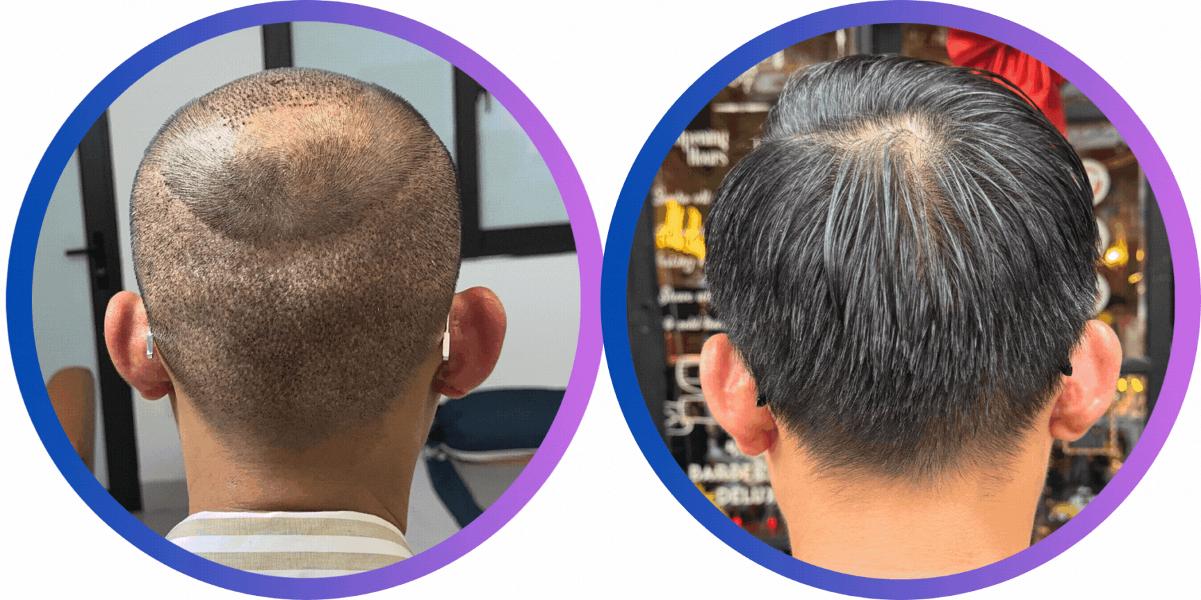 KẾT QUẢ 1 NĂM SAU CẤY TÓC DHI TRỊ HÓI 