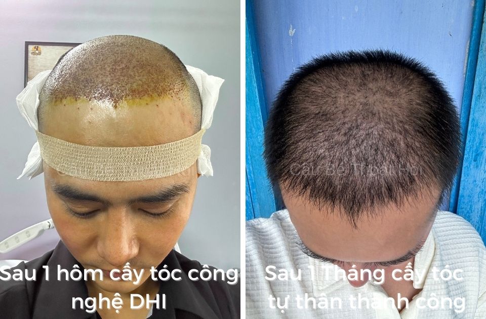 1 tháng sau cấy tóc tự thân phiên 2 (3100 nang tóc) điều trị rụng tóc hói đầu cậu bé thoát hói