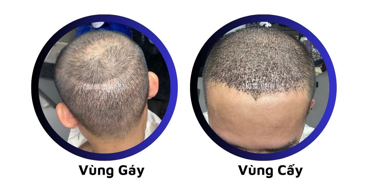 sau cấy tóc tự thân bằng công nghệ cấy DHI trị hói thành công 10 hôm của cậu bé thoát hói