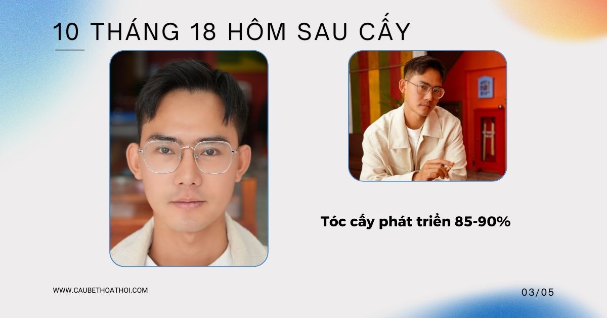KẾT QUẢ 10 THÁNG 18 HÔM SAU CẤY TÓC CHỮA HÓI THÀNH CÔNG CỦA CẬU BÉ THOÁT HÓI