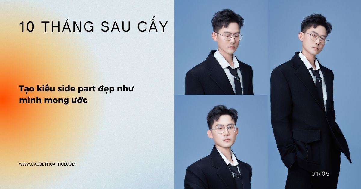 KẾT QUẢ 10 THÁNG SAU CẤY TÓC CHỮA HÓI THÀNH CÔNG CỦA CẬU BÉ THOÁT HÓI