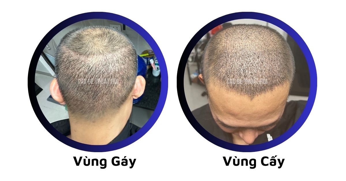 sau cấy tóc tự thân bằng công nghệ cấy DHI trị hói thành công 11 hôm của cậu bé thoát hói