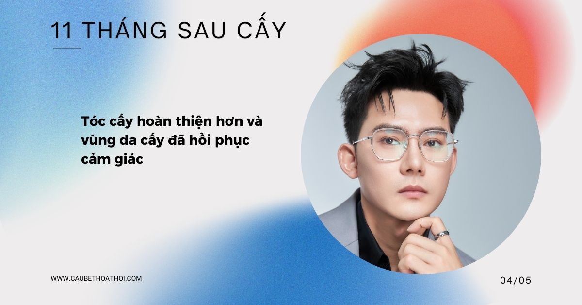 KẾT QUẢ 11 THÁNG SAU CẤY TÓC CHỮA HÓI THÀNH CÔNG CỦA CẬU BÉ THOÁT HÓI