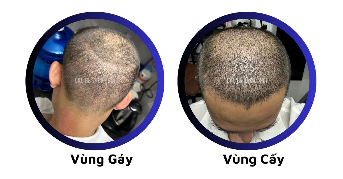 sau cấy tóc tự thân bằng công nghệ cấy DHI trị hói thành công 12 hôm của cậu bé thoát hói