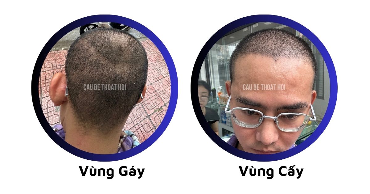 sau cấy tóc tự thân bằng công nghệ cấy DHI trị hói thành công 13 hôm của cậu bé thoát hói