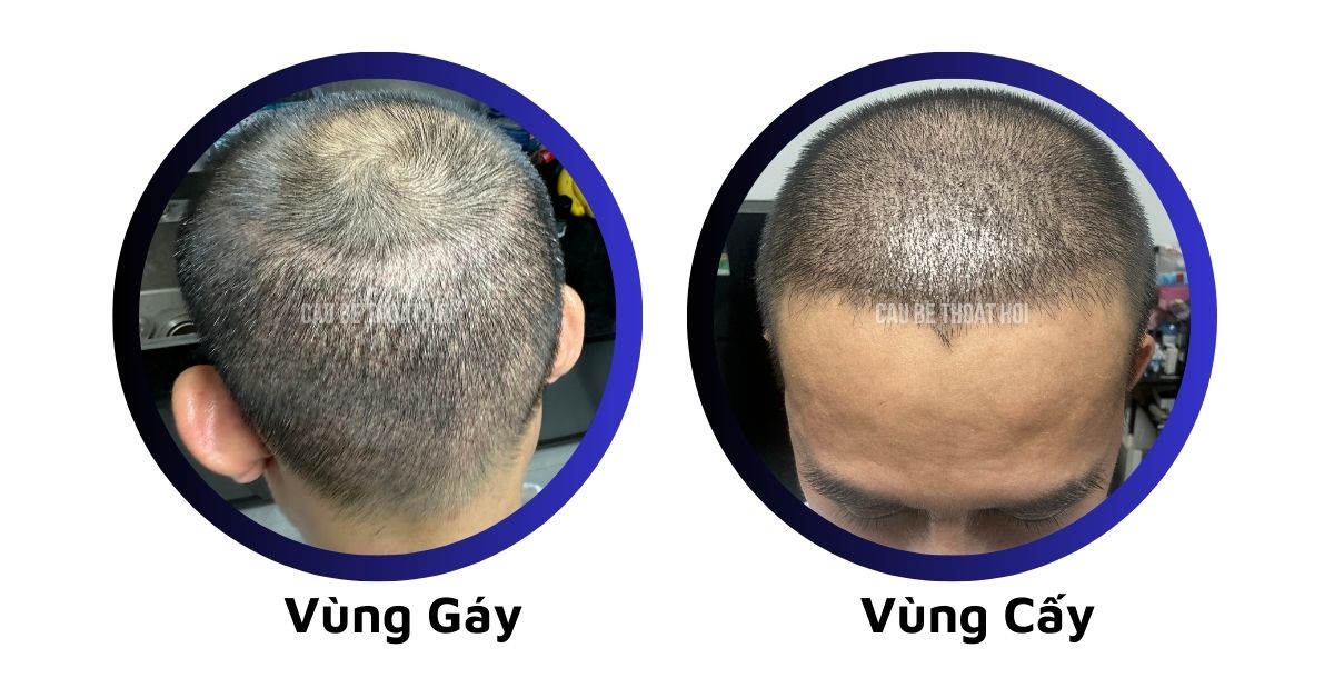 sau cấy tóc tự thân bằng công nghệ cấy DHI trị hói thành công 14 hôm của cậu bé thoát hói
