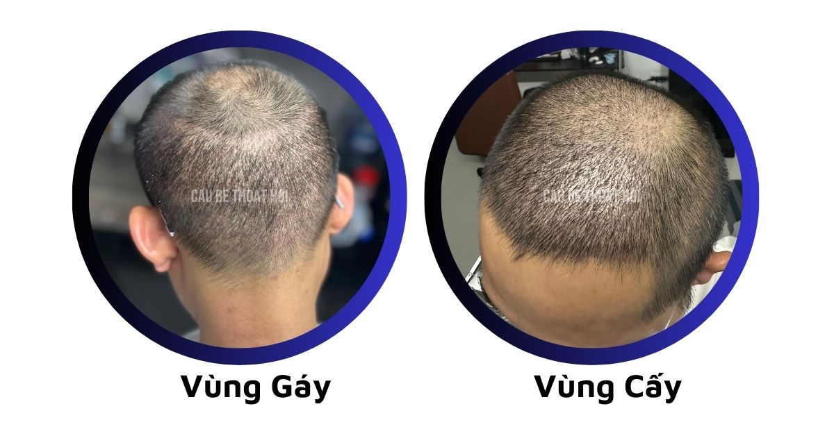 sau cấy tóc tự thân bằng công nghệ cấy DHI trị hói thành công 15 hôm của cậu bé thoát hói