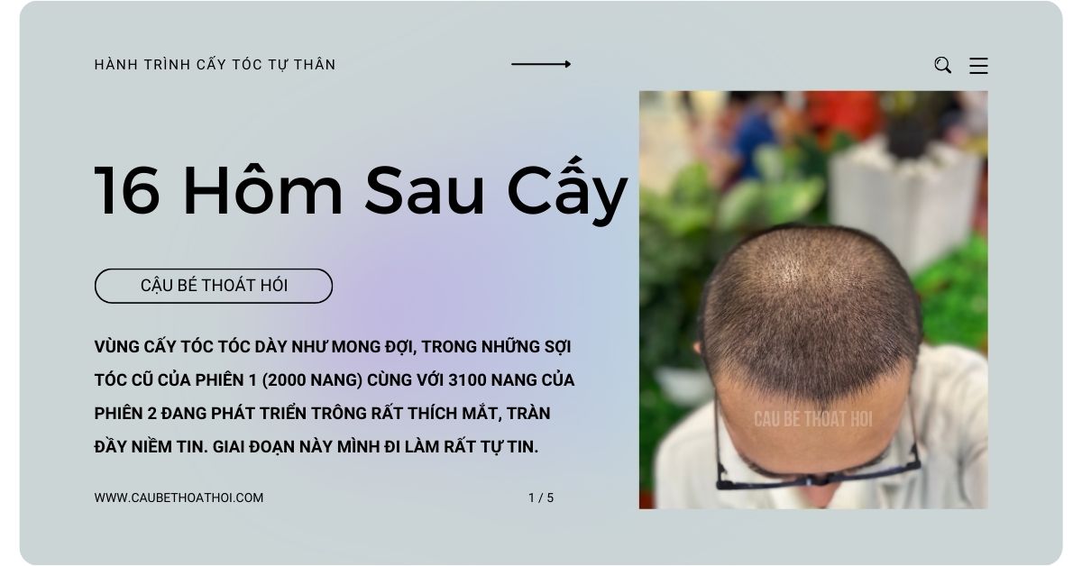 sau cấy tóc chữa hói thành công 1 tháng cậu bé thoát hói bằng công nghệ cấy tóc DHI