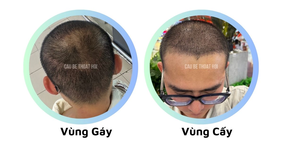 sau cấy tóc chữa hói thành công 16 hôm cậu bé thoát hói bằng công nghệ cấy tóc DHI