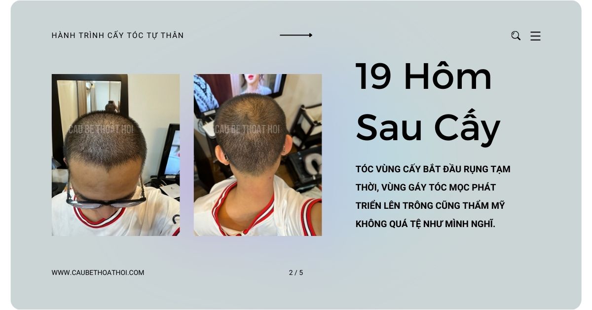 sau cấy tóc chữa hói thành công 1 tháng cậu bé thoát hói 