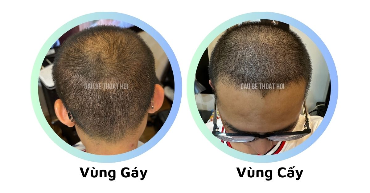 sau cấy tóc chữa hói thành công 19 hôm cậu bé thoát hói bằng công nghệ cấy tóc DHI
