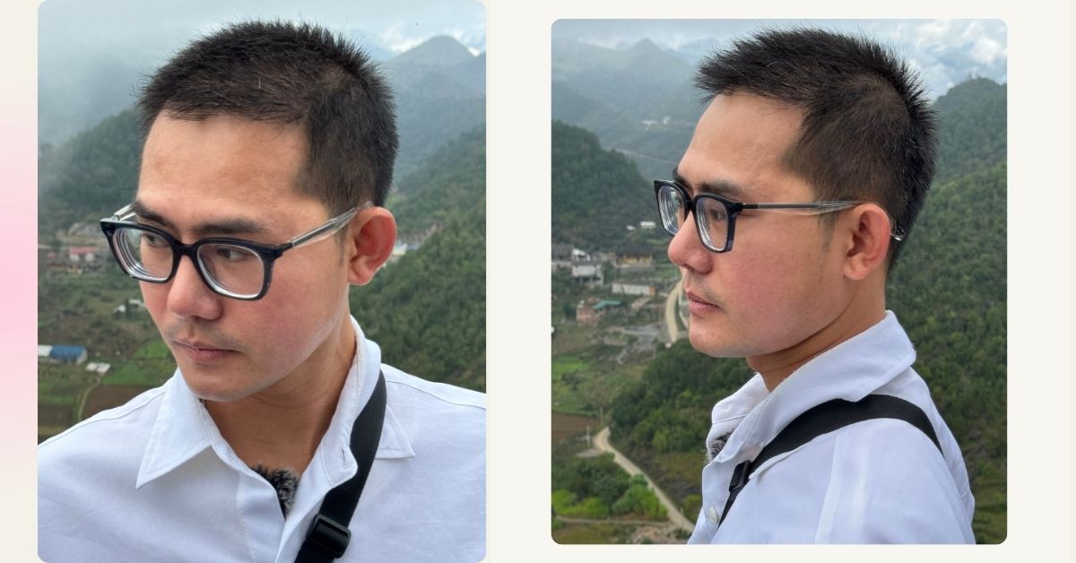 2 THÁNG 8 HÔM SAU CẤY TÓC DÙ PHẢI NÓI LÀ TÓC CẤY CHƯA CÓ DÀY NHIỀU