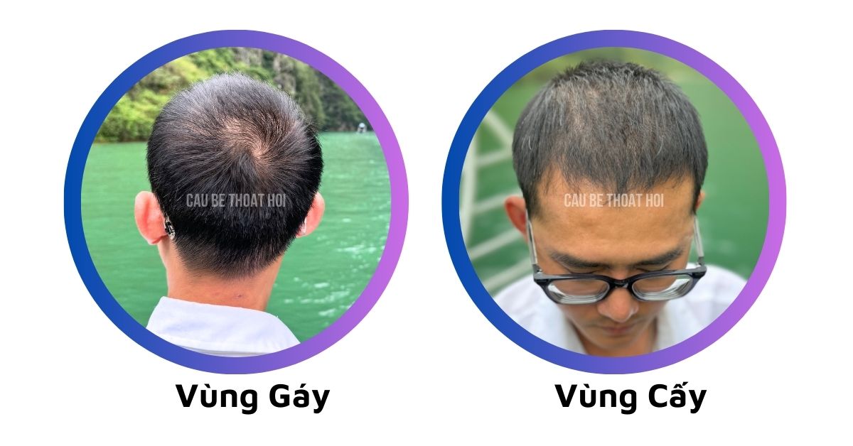 sau 2 tháng 11 hôm cấy tóc chữa hói 