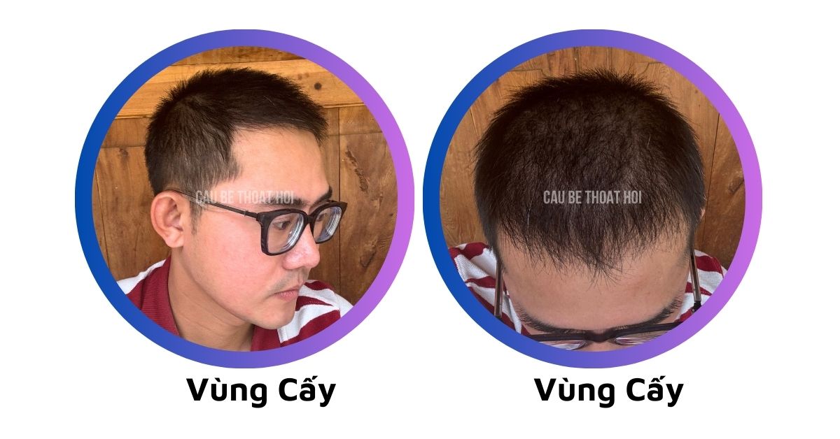 sau 2 tháng 8 hôm cấy tóc tự thân chữa hói bằng công nghệ cấy tóc DHI của cậu bé thoát hói