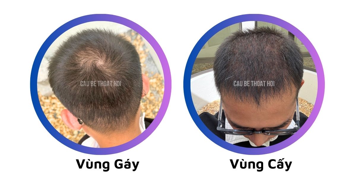sau 2 tháng cấy tóc tự thân chữa hói bằng công nghệ cấy tóc DHI của cậu bé thoát hói