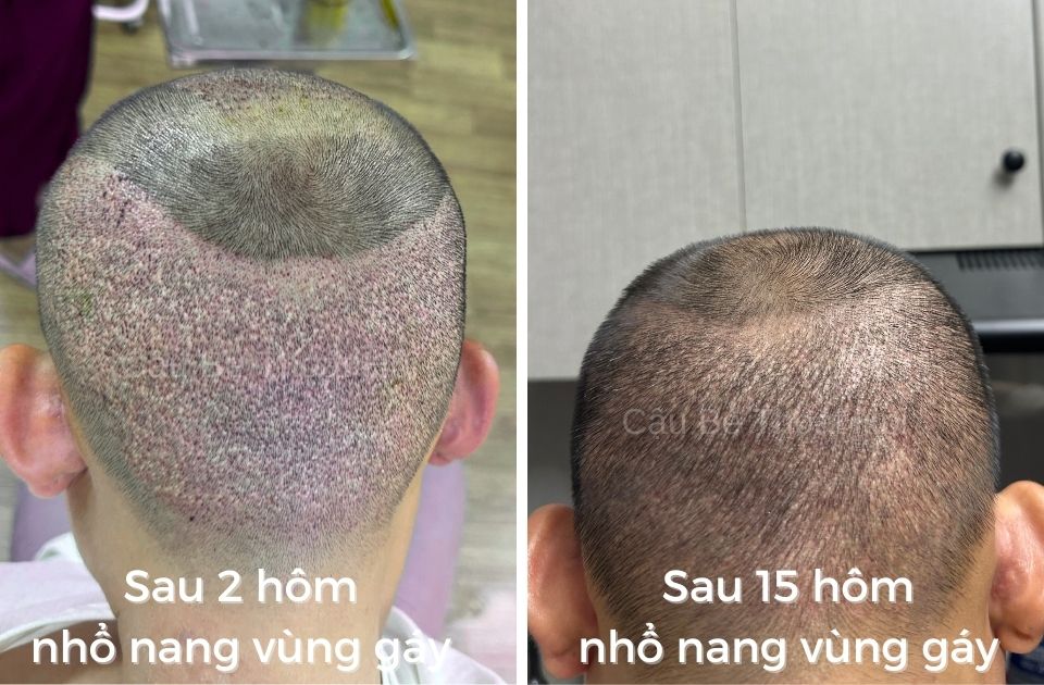 2 tuần sau cấy tóc tự thân chữa hói và đây là vùng gáy hiến nang tóc để cấy tóc DHI của cậu bé thoát hói