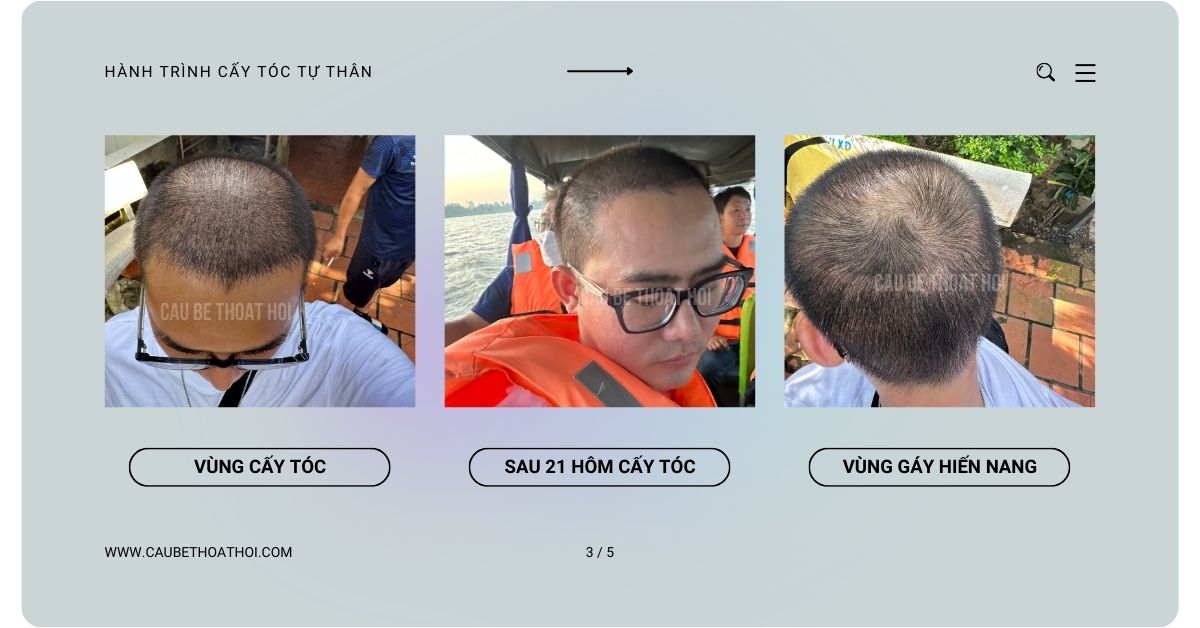 sau cấy tóc chữa hói thành công 1 tháng cậu bé thoát hói bằng công nghệ cấy tóc DHI