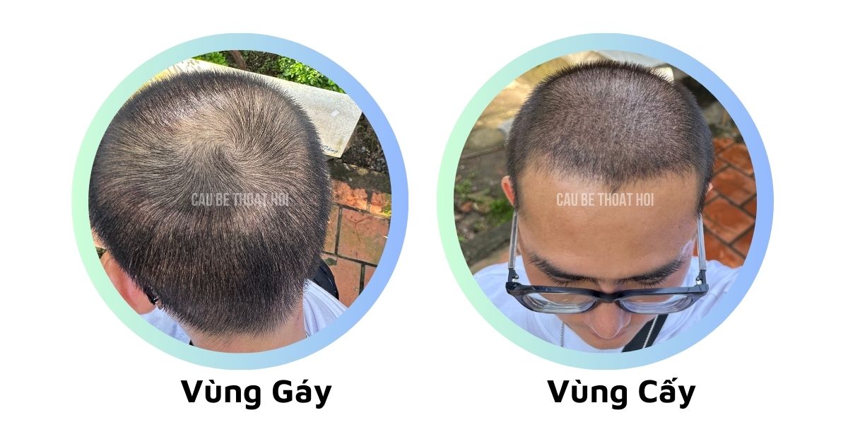 sau cấy tóc chữa hói thành công 3 tuần cậu bé thoát hói bằng công nghệ cấy tóc DHI